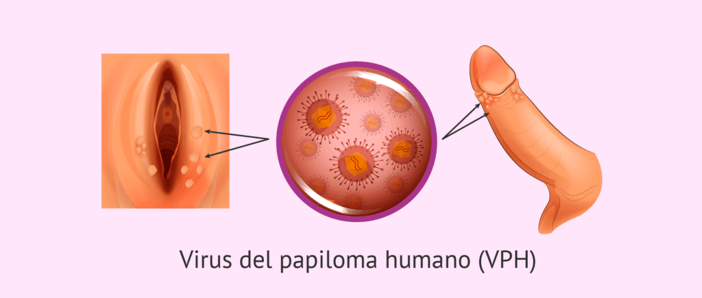 Ilustración de Verrugas en Genitales causados por el VPH